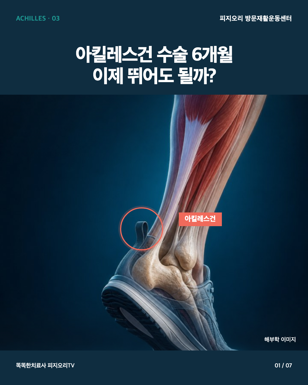 아킬레스건 파열 수술 후 러닝, 6개월이면 가능할까요? 논문 기반 7가지 기준